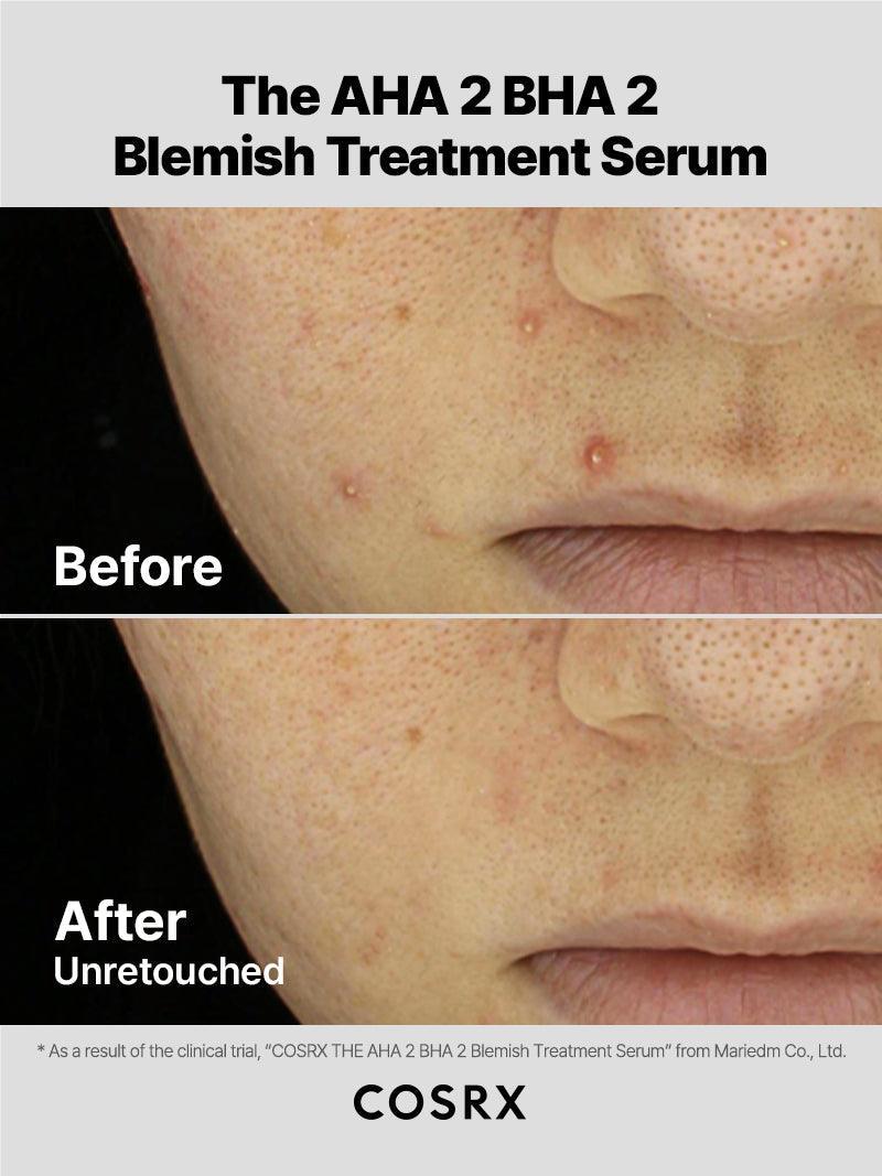 COSRX - The AHA 2 BHA 2 Blemish Treatment Serum 20ml